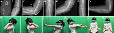 Comparison of midterm efficacy of Kirschner wires and elastic intramedullary nails after closed reduction of Judet type 3 radial neck fractures in children: a multicenter study